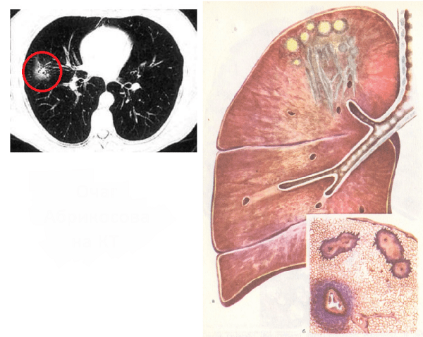 Инфильтративный туберкулез легких: заразен или нет, в фазе распада и обсеменения
