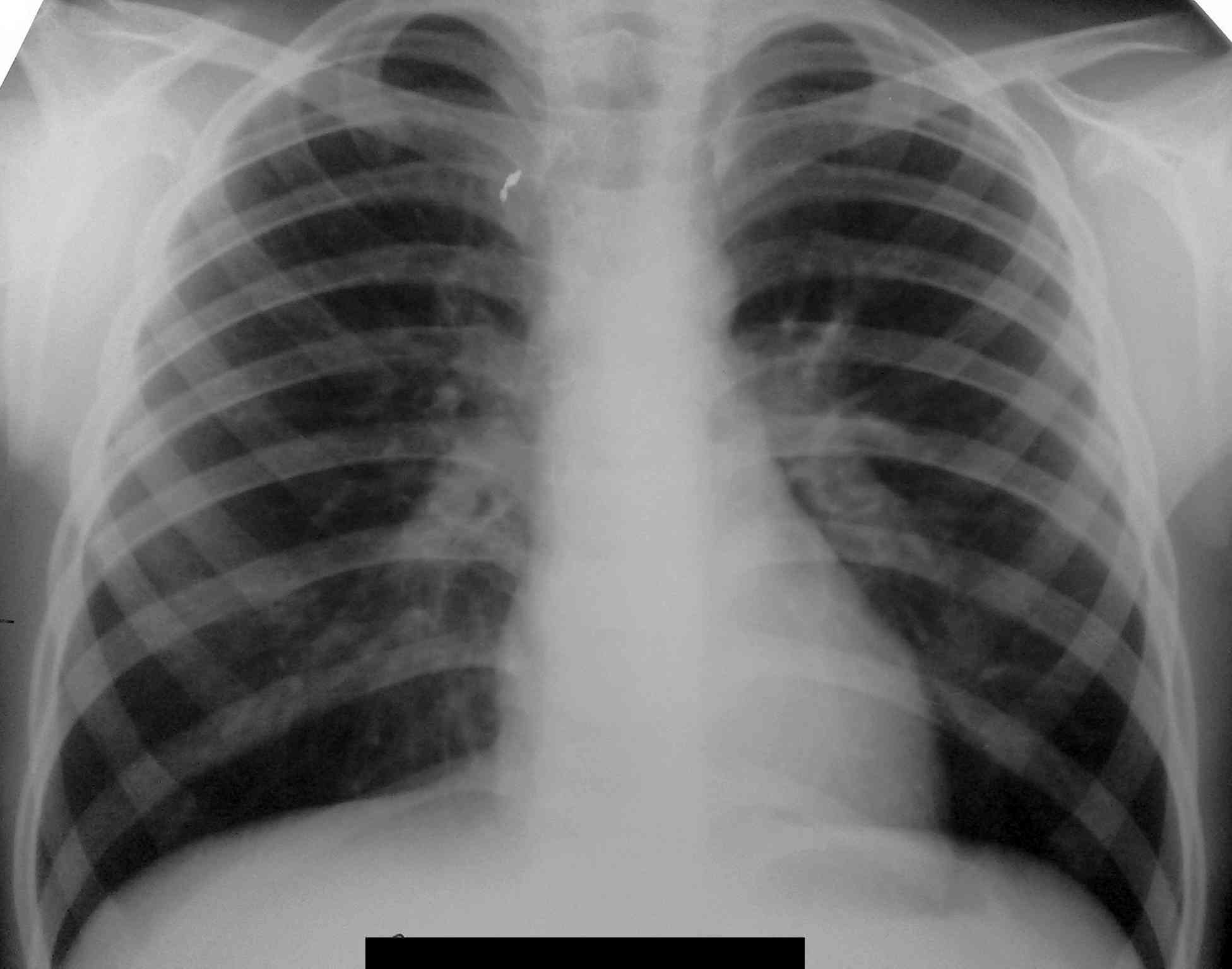 Пневмония на рентгене: как выглядит воспаление легких на рентгеновском снимке, рентгенологические признаки