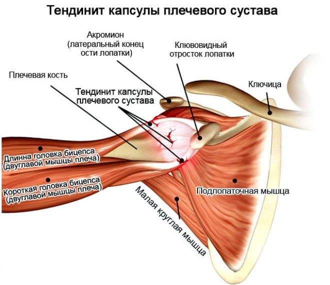 Тендинит плечевого сустава: симптомы и лечение