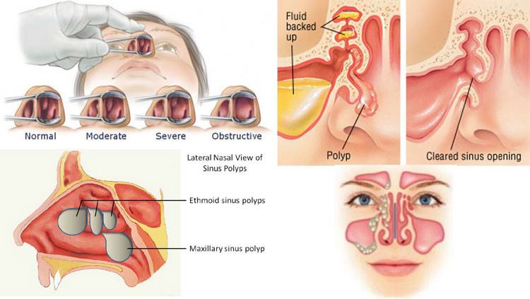 Воспаление носовых пазух - как снять в носу, лечение слизистой, симптомы, чем лечить воспаленный при насморке