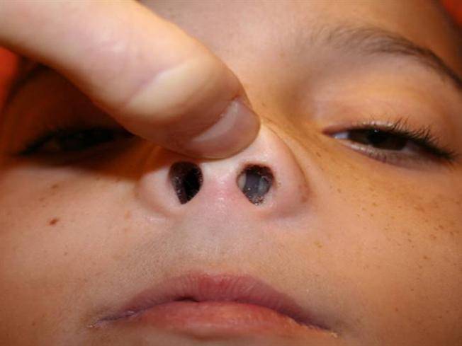 Полипы в носу у детей: причины проявления, симптомы и лечение