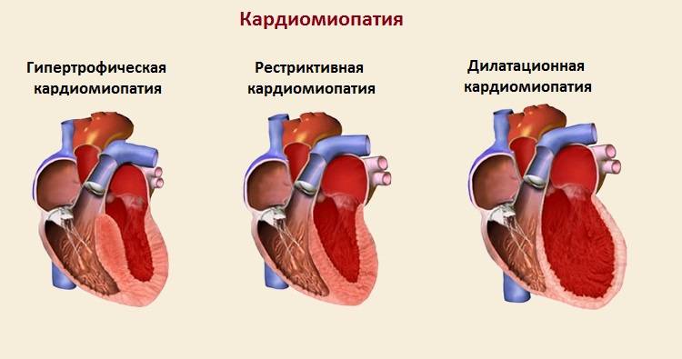 Причины, диагностика и прогноз при дилатационной кардиомиопатии