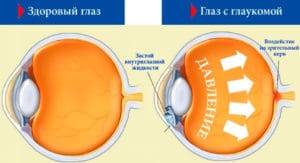 Лечение глаукомы в домашних условиях – 8 рецептов - народная медицина | природушка.ру