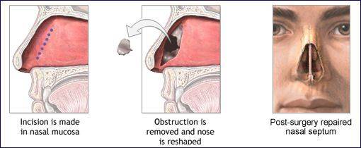 Последствия искривления носовой перегородки; лечение - yourlor