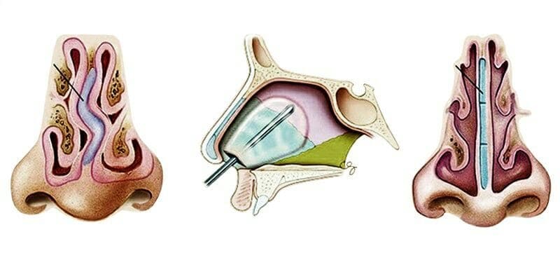 Септопластика носовой перегородки: поможет ли операция восстановить свободное дыхание