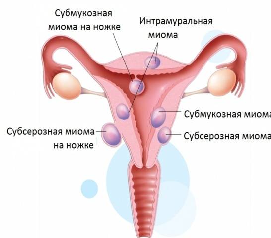 ᐉ лечение эндометриоза и миомы при климаксе - sp-medic.ru