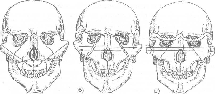 Классификация и методы лечения переломов верхней и нижней челюсти