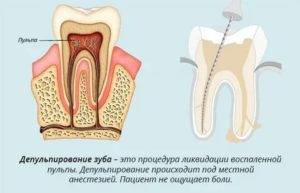 Протезирование зубов. случаи необходимости депульпирования зуба