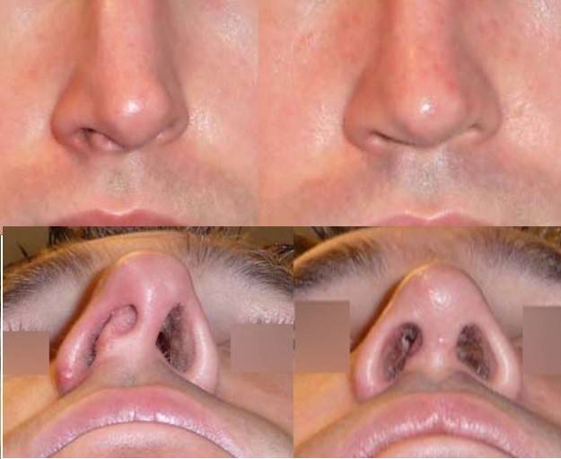 Ринопластика: исправление носовой перегородки, вмешательство при гайморите, насморке, после септопластики и с остеотомией