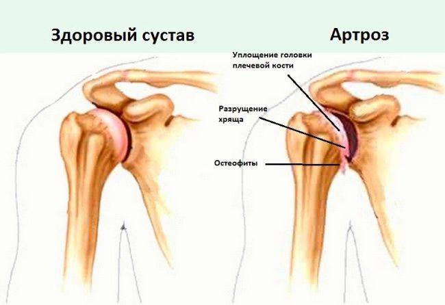 Остеоартроз плечевого сустава: симптомы и лечение хрящевой ткани