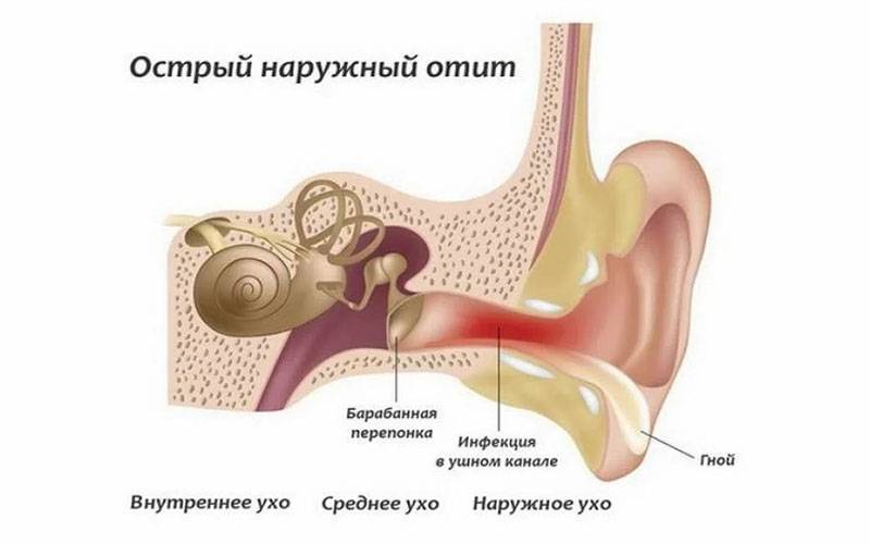Наружный диффузный отит, как лечить диффузный отит наружного уха?