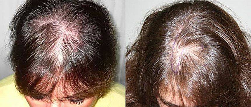 Лечение при андрогенном выпадении волос у женщин