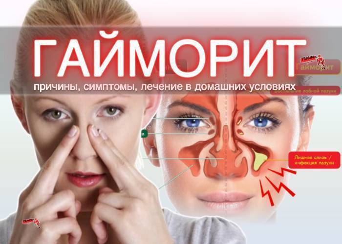 Гайморит: осложнения и последствия на глаза, мозг, уши у взрослых и детей, симптомы