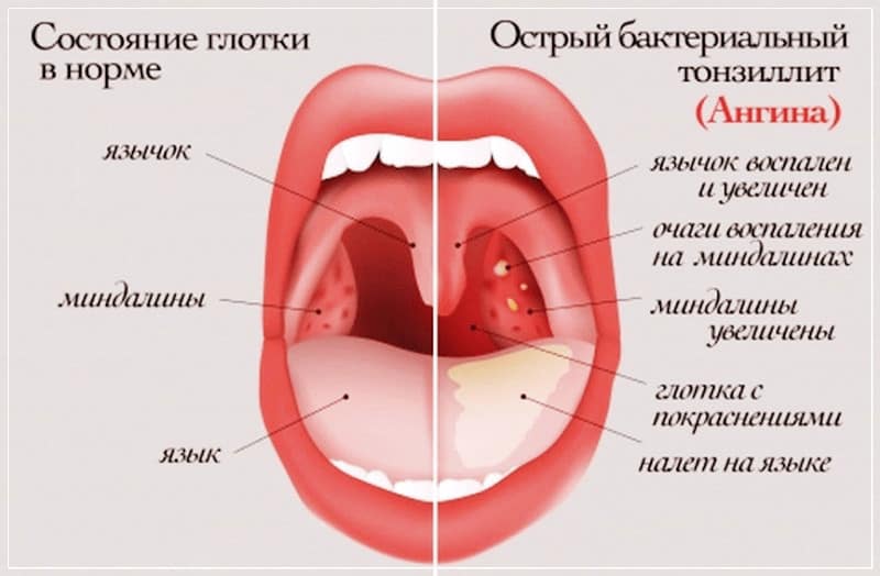 Острый тонзиллит (ангина): признаки, лечение