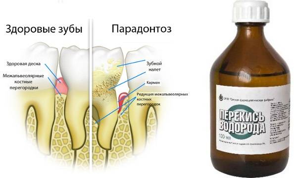 Пародонтоз лечение в домашних условиях перекисью водорода и содой - стоматология