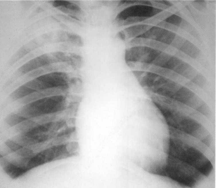 Фазы (стадии), симптомы, лечение и заразность инфильтративного туберкулеза легких с распадом и без