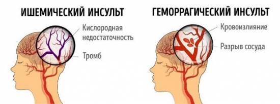Онмк (острое нарушение мозгового кровообращения): первые признаки, описание симптомов, первая помощь, лечение и прогноз