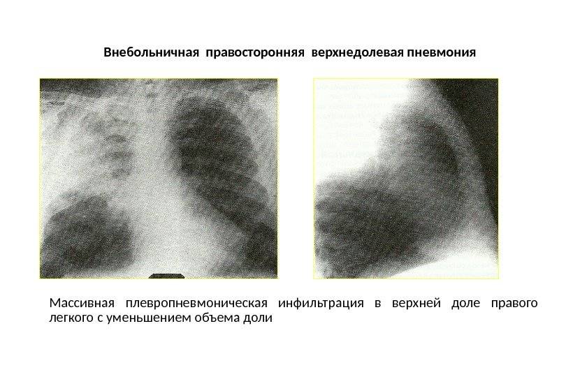 Верхнедолевая пневмония: симптомы, лечение | pnevmonya.ru