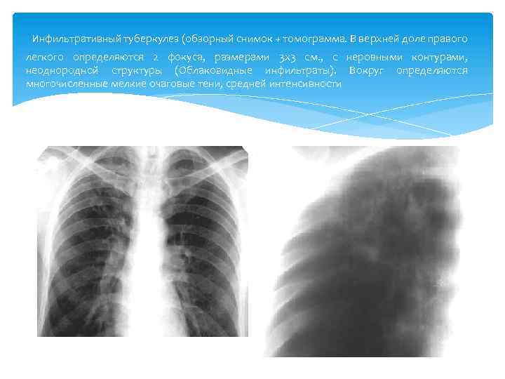 Мкб 10 туберкулез легких