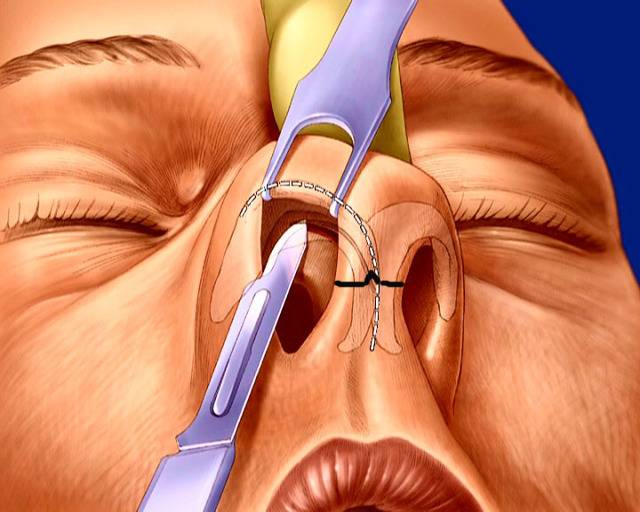 Искривление носовой перегородки – симптомы, признаки, диагностика, причины.  лечение искривления: показания, противопоказания к операции