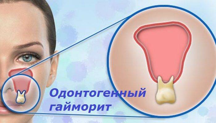 Народное лечение гнойного гайморита - болезни носа