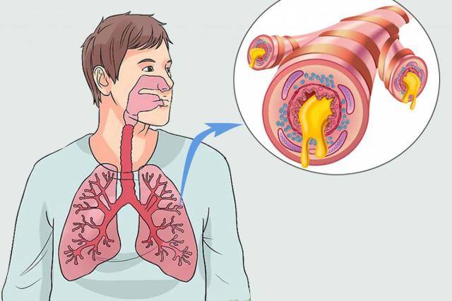 Сухой кашель при бронхите у взрослого, как и чем лечить сухой бронхиальный кашель?