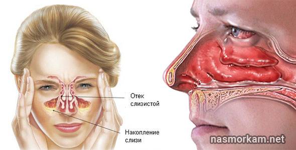 Отек в носу без насморка: возможные причины, лечение