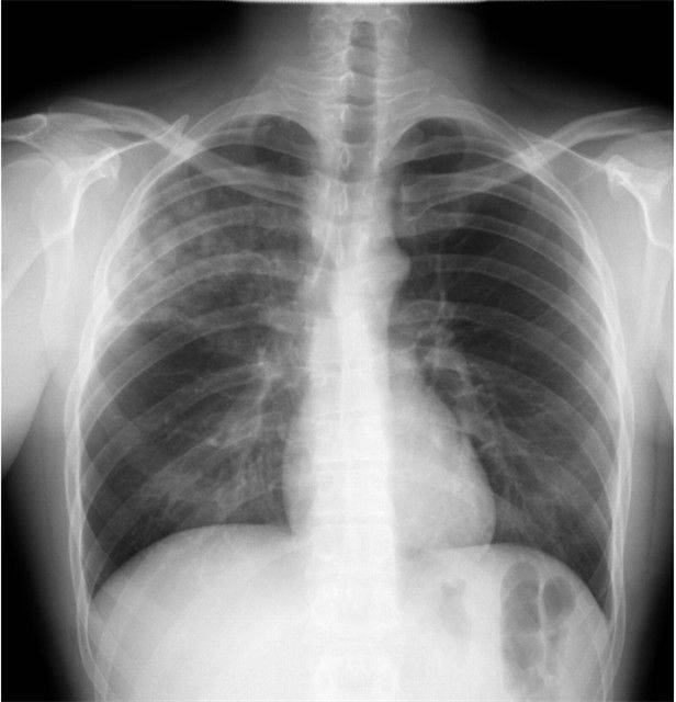 Левосторонняя пневмония - верхнедолевая правосторонняя, симптомы и лечение воспаления легких при туберкулезе доли правого или левого