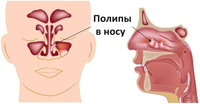Полипы в носу у ребёнка: фото, симптомы, лечение и причины возникновения