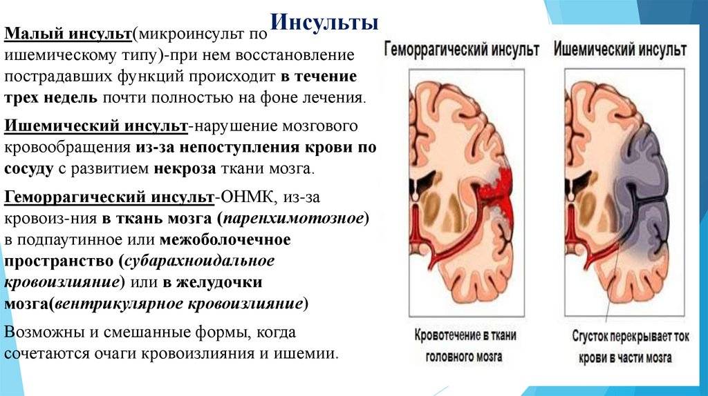 Лечение ишемического инсульта головного