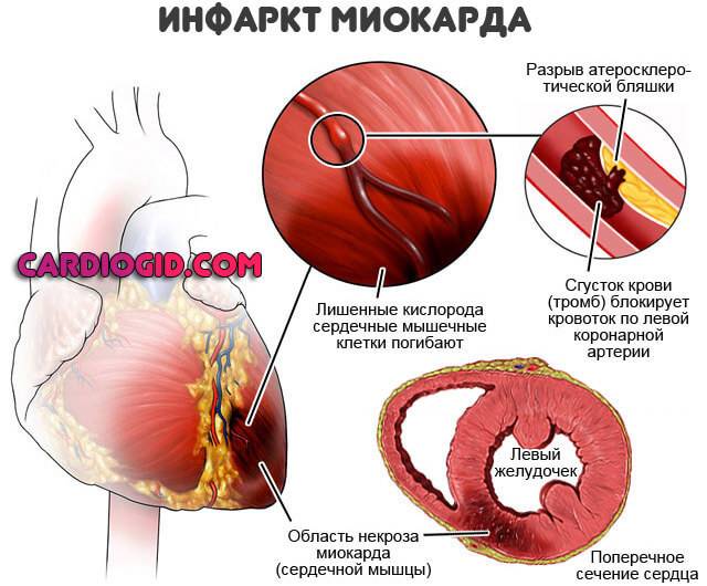 Основные осложнения инфаркта миокарда и меры по их предупреждению
