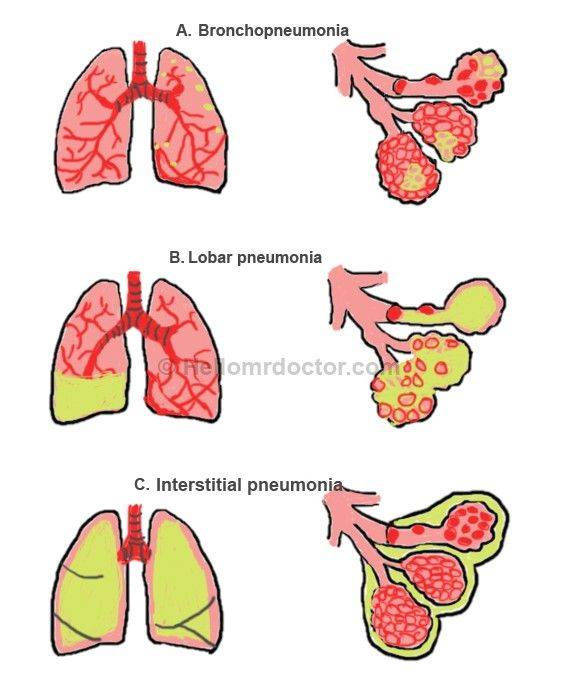 Что такое пневмонит и чем отличается от пневмонии?