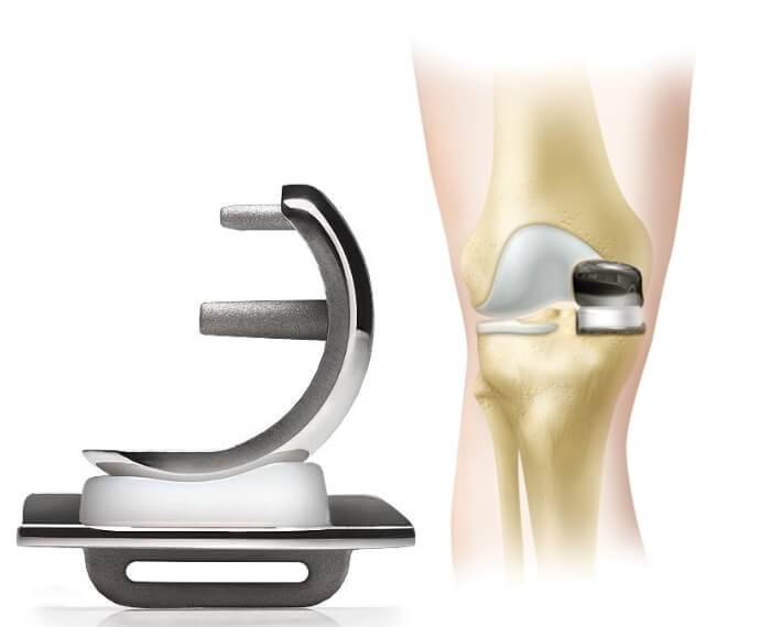 Срок службы эндопротеза коленного сустава зиммер