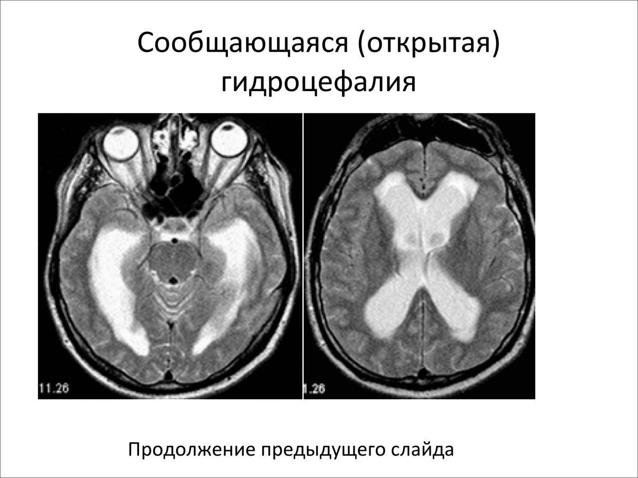 Симптомы гидроцефалии головного мозга у взрослых