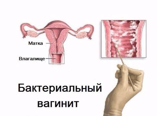Бактериальный вагинит | wmj.ru