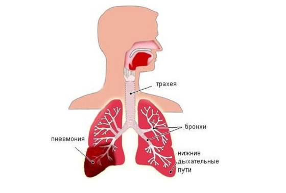 Пневмония без кашля: может ли такое быть?