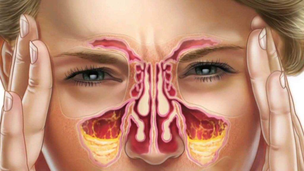 Воспаление пазухи носа: симптомы. лечение. как установить причину?