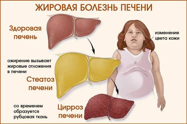 Диета при жировом гепатозе печени
