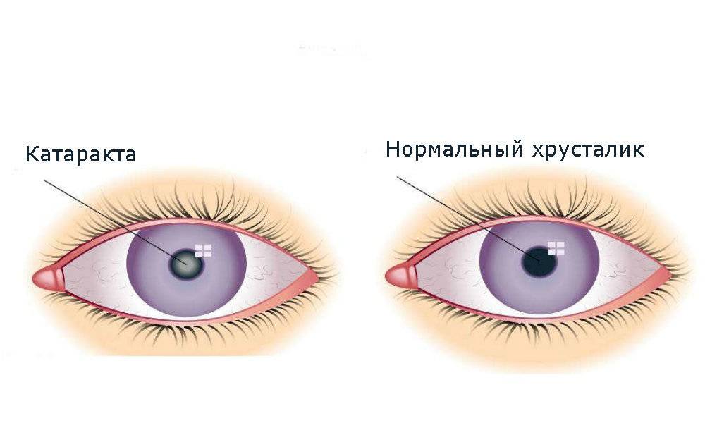 Лечение катаракты народными средствами в домашних условиях