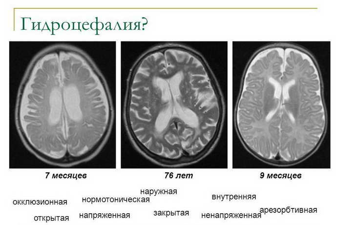 Наружная гидроцефалия головного мозга у взрослого: что это такое, симптомы, причины, лечение
