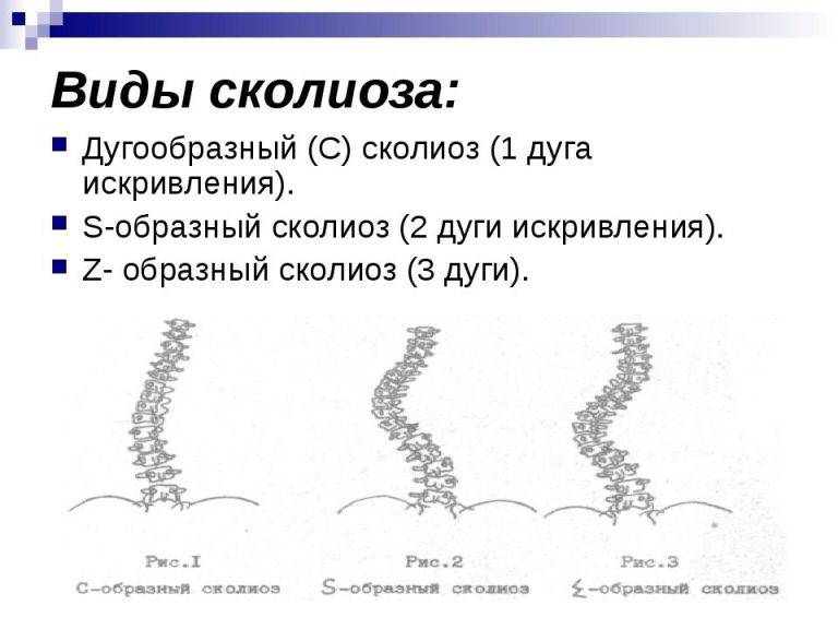 Степени сколиоза: классикация по разным критерям