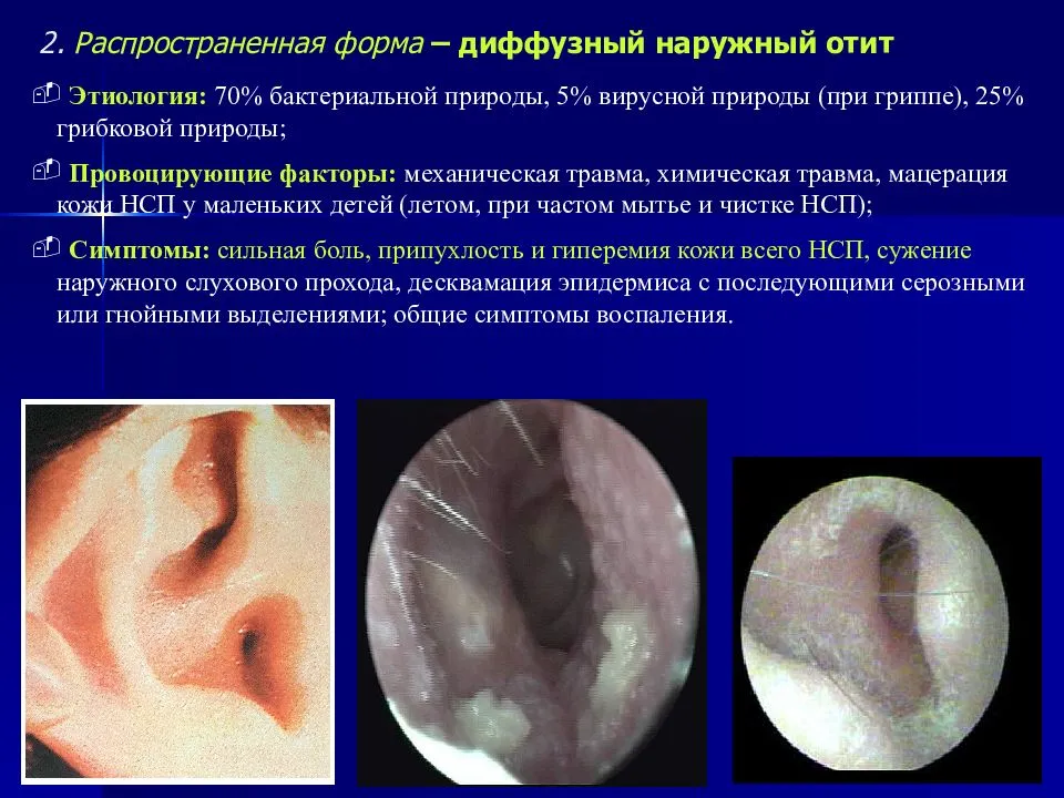 Отит среднего уха – симптомы и лечение, которое действительно поможет