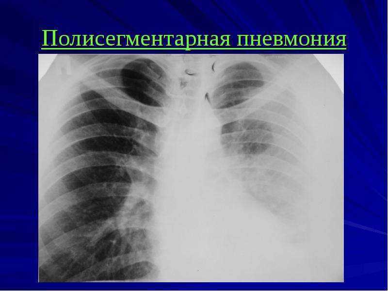 Двухсторонняя лёгочная пневмония