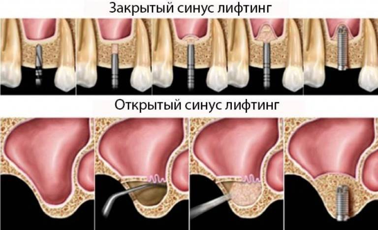Синус лифтинг с одномоментной имплантацией зубов