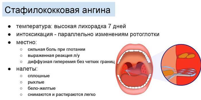Симптомы и лечение ангины у взрослых: как передается и чем грозит — чтобы горло не болело