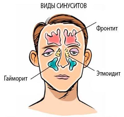 Можно ли греть нос при гайморите и как это делать правильно pulmono.ru
можно ли греть нос при гайморите и как это делать правильно