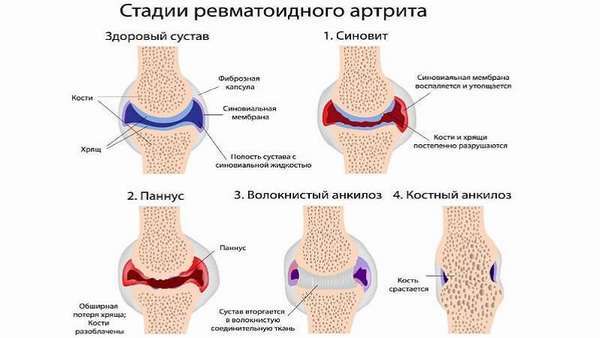 Ревматоидный артрит клинические рекомендации (2018-2019) минздрава россии