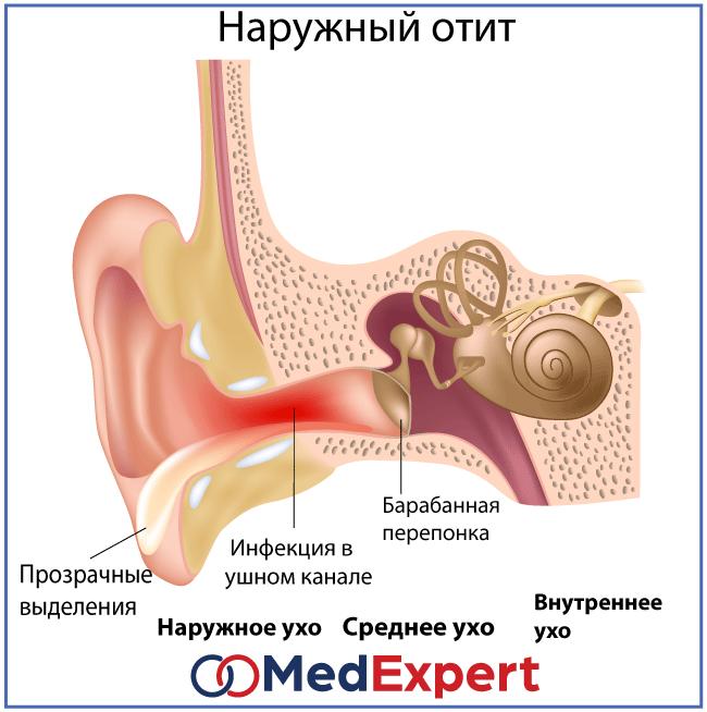 Диффузный отит - наружный, острый, симптомы и лечение уха у взрослых, как лечить