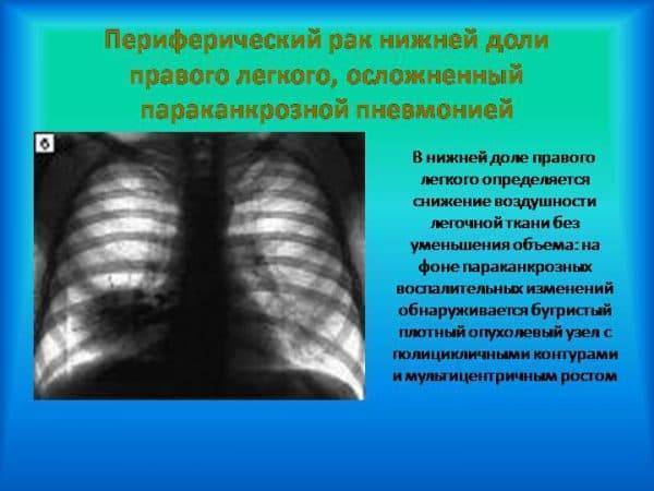 Параканкрозная пневмония - лор-заболевания