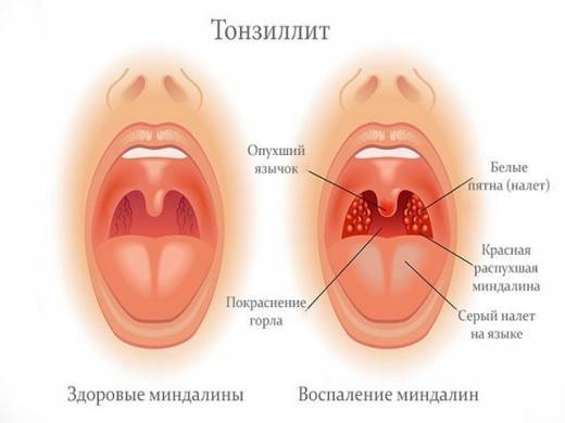 Симптомы вирусной ангины у детей, фото горла и комплексное лечение